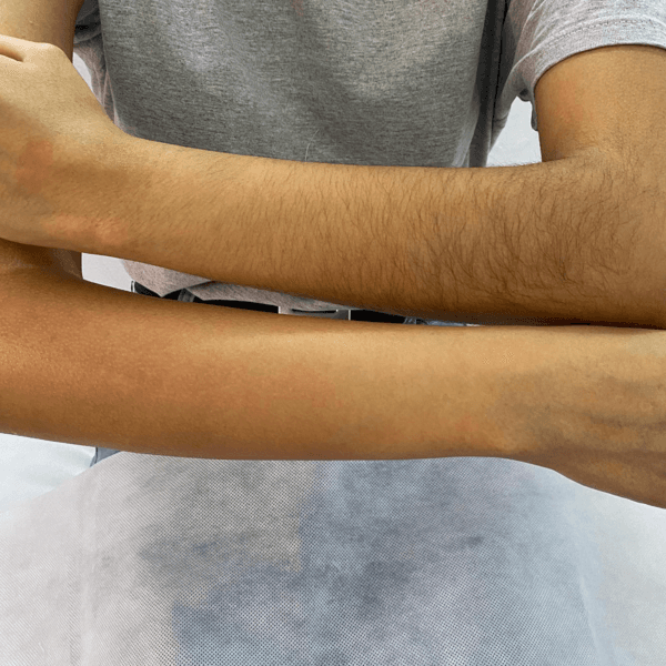 Depilación de brazos