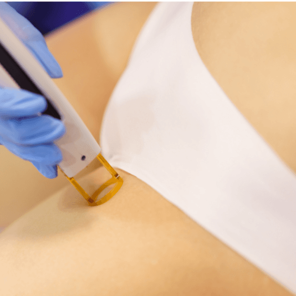 Depilación Láser Ingle 12 Sesiones