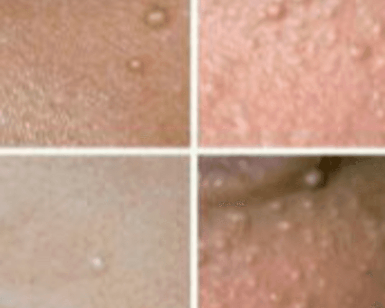 EXTRACCIONES DE MILIUMS (COMBINADO CON OTRO SERVICIO TIENE DESCUENTO)