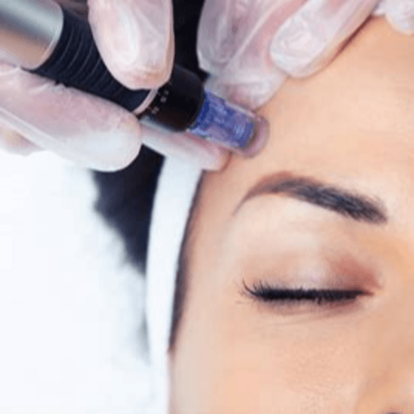 MICRONEEDLING C/SERUMS INDICADOS