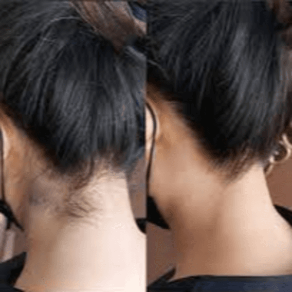 Depilación de cuello