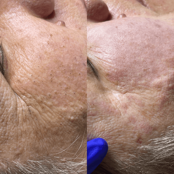 LIMPIEZA FACIAL PROFUNDA