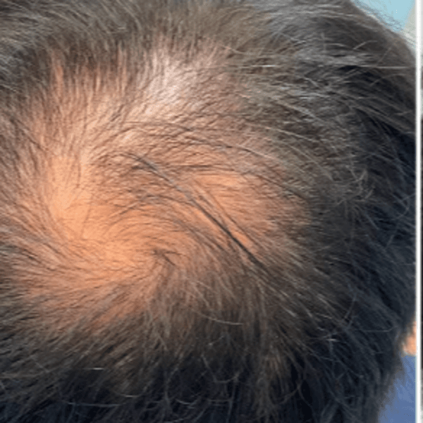 DERMAPEN CAPILAR (la solución a la caída del cabello)