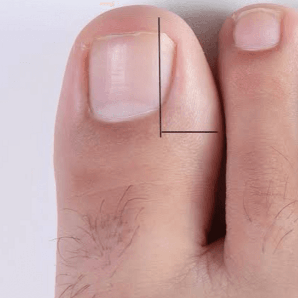 Corte de Uña Encarnada