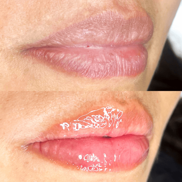 PACK full🔥(Lifting+Laminado+Hidralips)