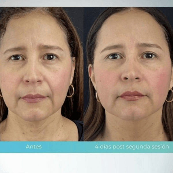 Bioregenerador