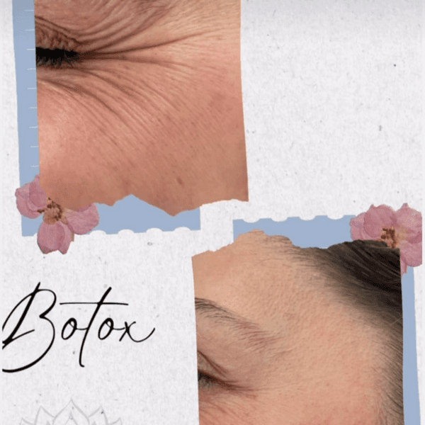Botox