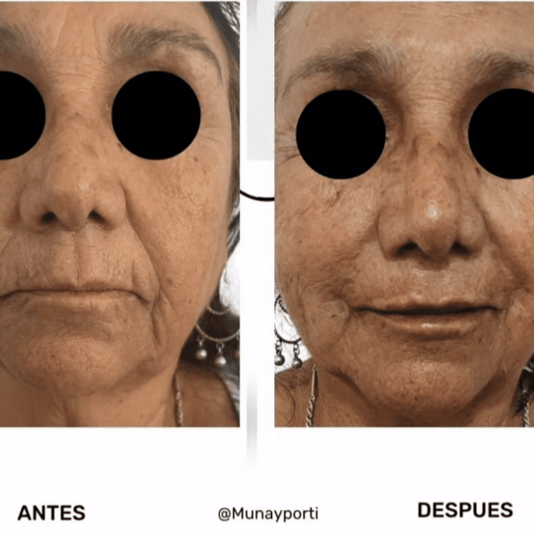 Hilos Revitalizantes (10 u)