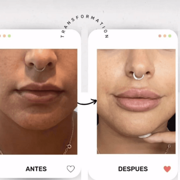Relleno de labios