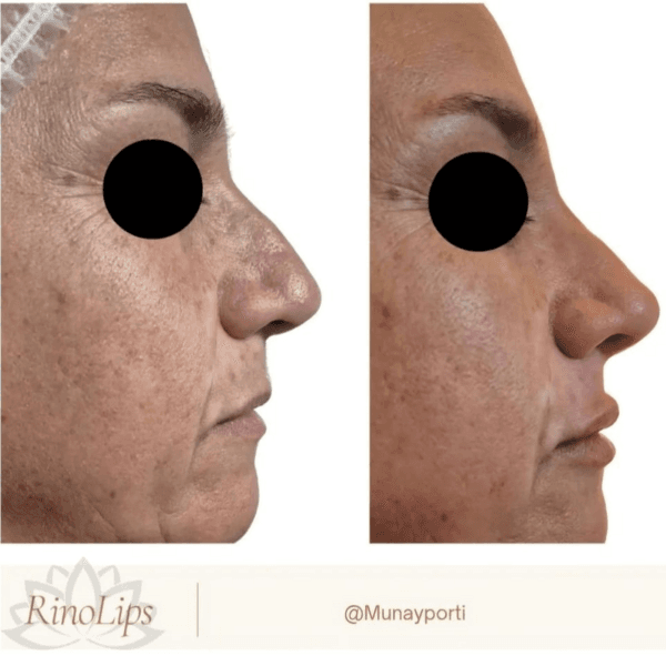 Rinolips