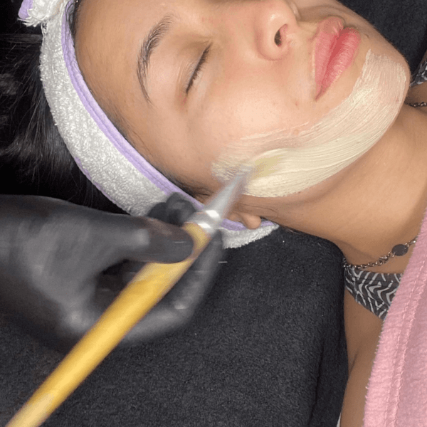 Peeling x 4 sesiones