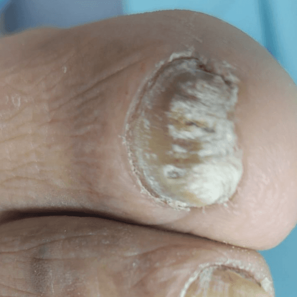 Podología c/ Micosis y/o Atrofia e Hipertrofia Ungueal (uñas) Micosis Piel