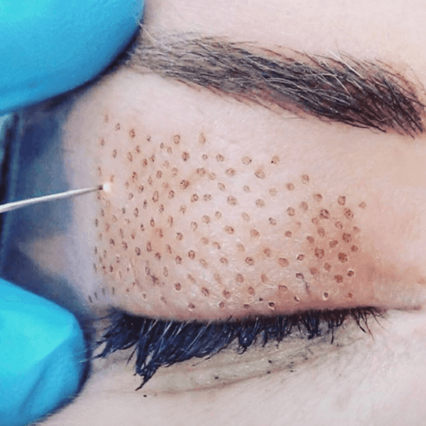 BLEFAROPLASTIA SIN CIRUGIA