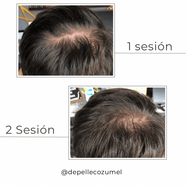 Regeneración capilar/hair regeneration