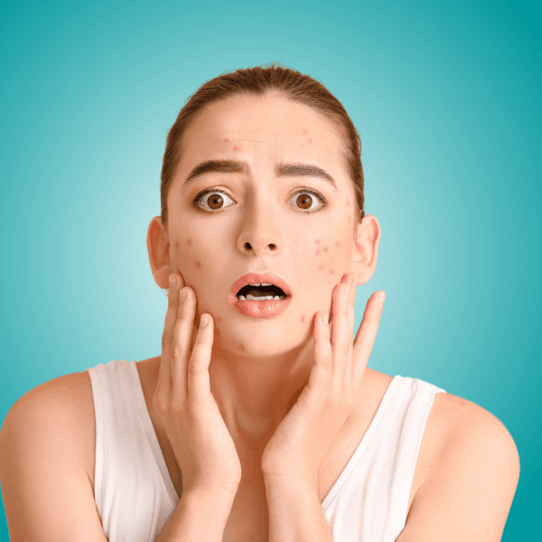 LIMPIEZA PARA ACNÉ/ADOLECENTE