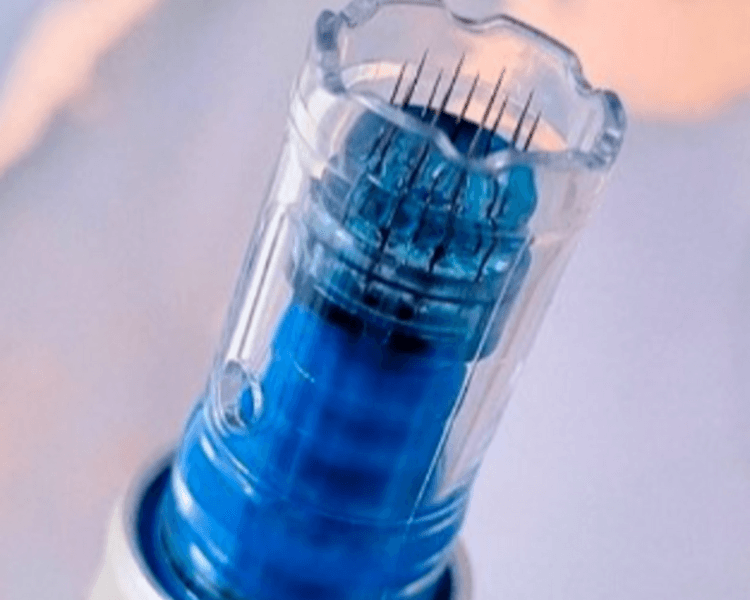 Microneedling