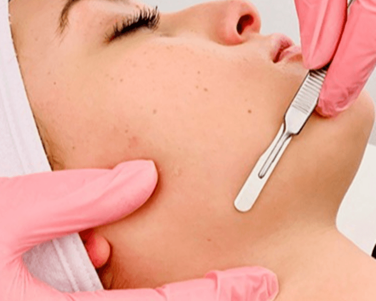 Dermaplaning