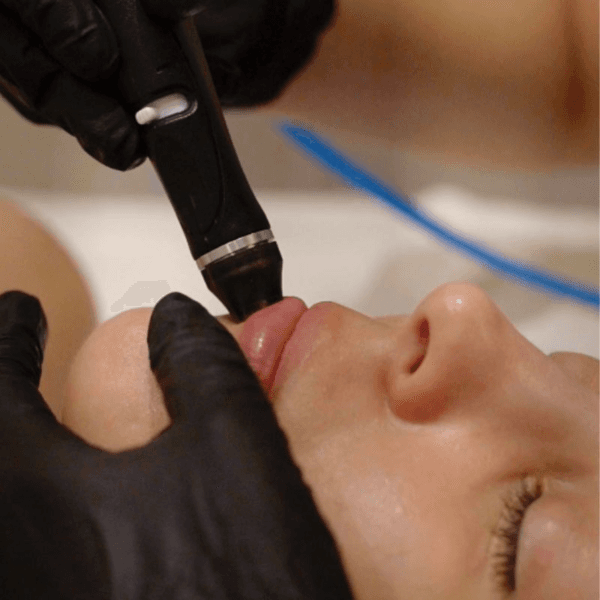 Hydrafacial Perk - Labios