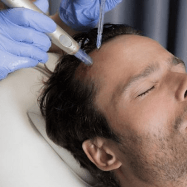 Tratamiento capilar con Dermapen