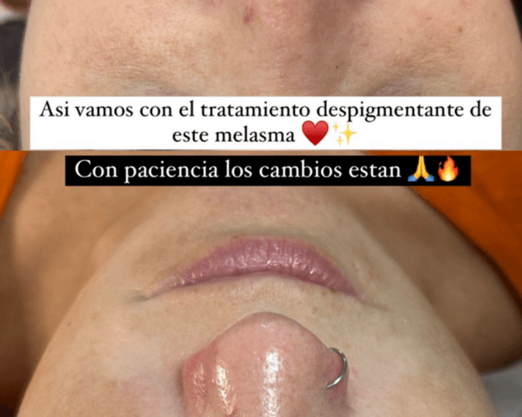 Tratamiento despigmentante intensivo